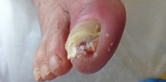 Der Reservoir und die Quelle dermatophytischer Pilze sind eine kranke Person